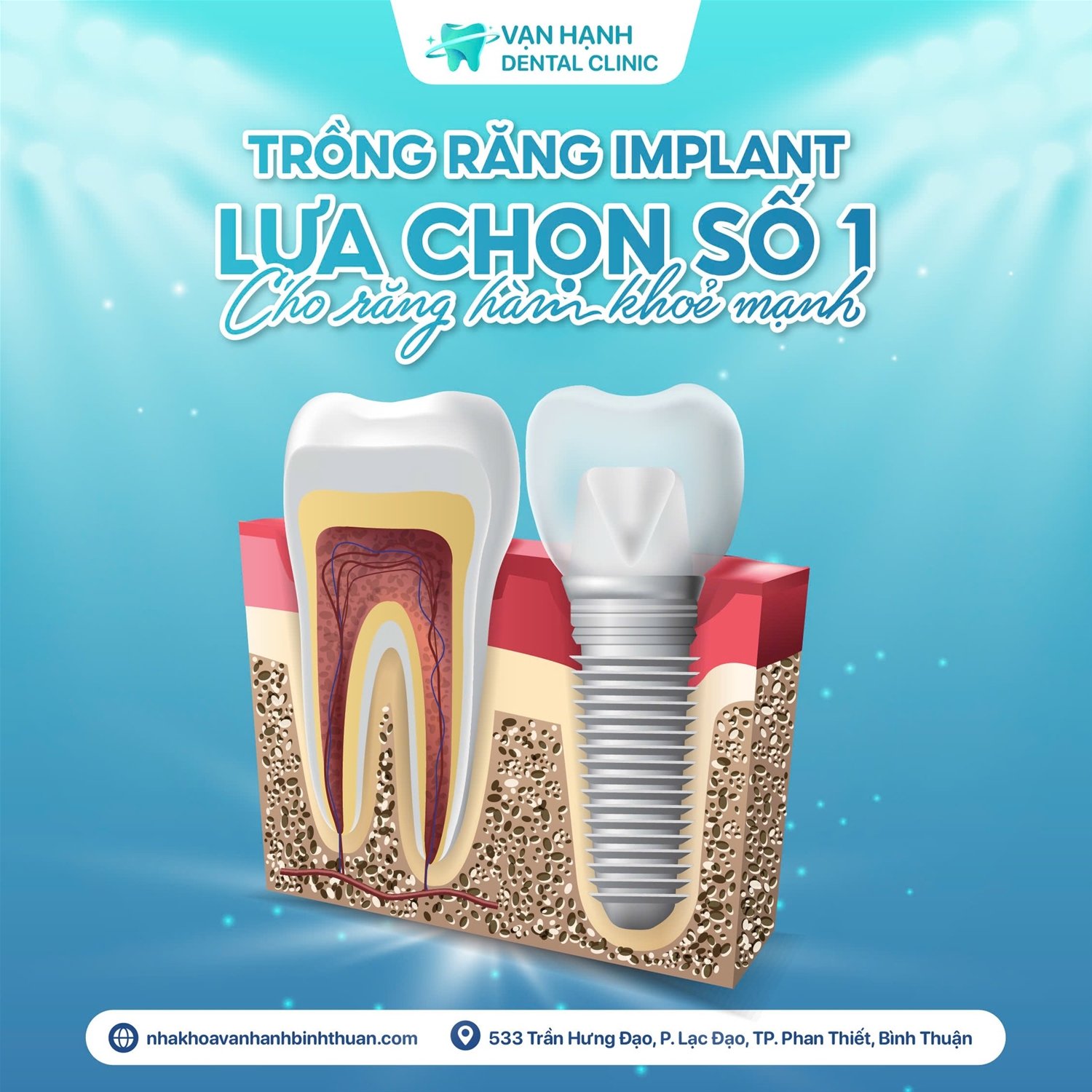 TRỒNG RĂNG IMPLANT - LỰA CHỌN SỐ 1 CHO HÀM RĂNG KHOẺ MẠNH