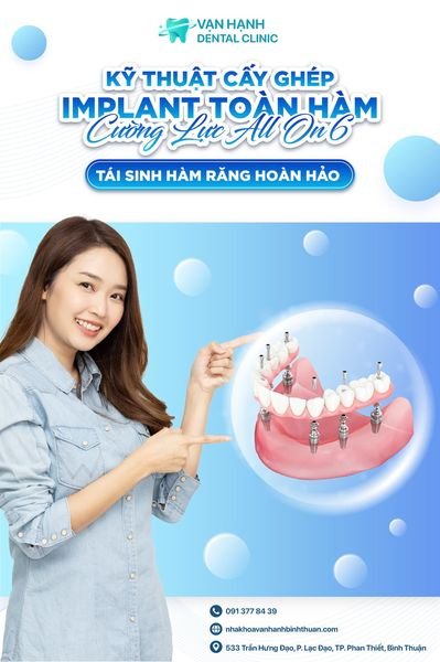 KỸ THUẬT CẤY GHÉP IMPLANT TOÀN HÀM CƯỜNG LỰC ALL ON 6: TÁI SINH HÀM RĂNG HOÀN HẢO