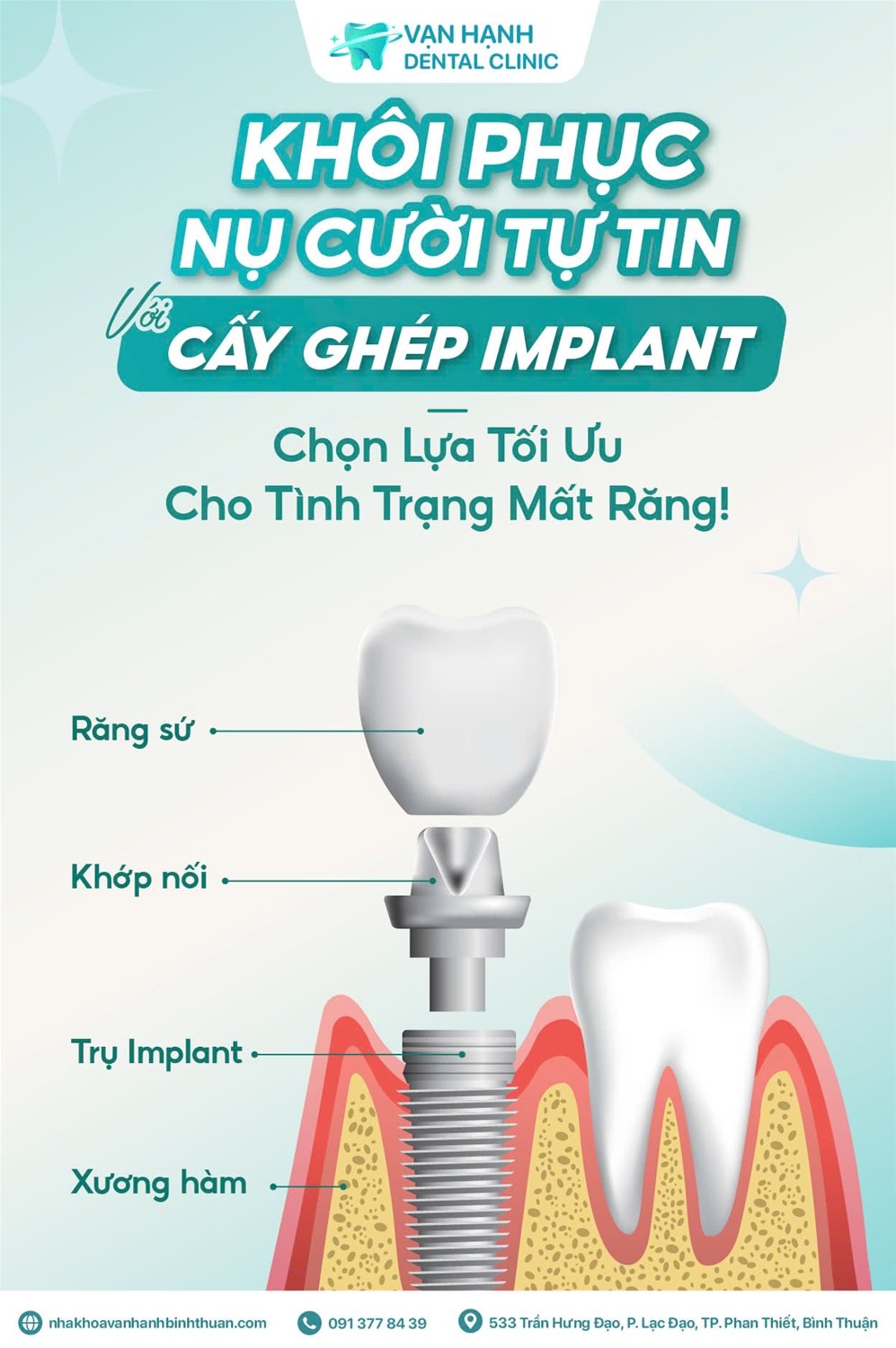KHÔI PHỤC NỰ CƯỜI TỰ TIN VỚI CẤY GHÉ IMPLANT - CHỌN LỰA TỐI ƯU CHO TÌNH TRẠNG MẤT RĂNG