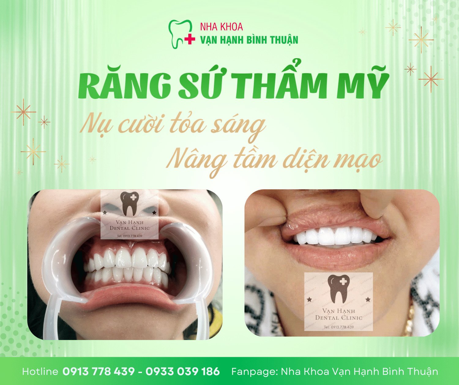 Dịch vụ Răng sứ thẩm mỹ tại nha khoa Vạn Hạnh Bình Thuận